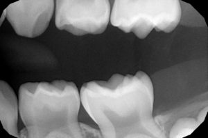 early cavity xray