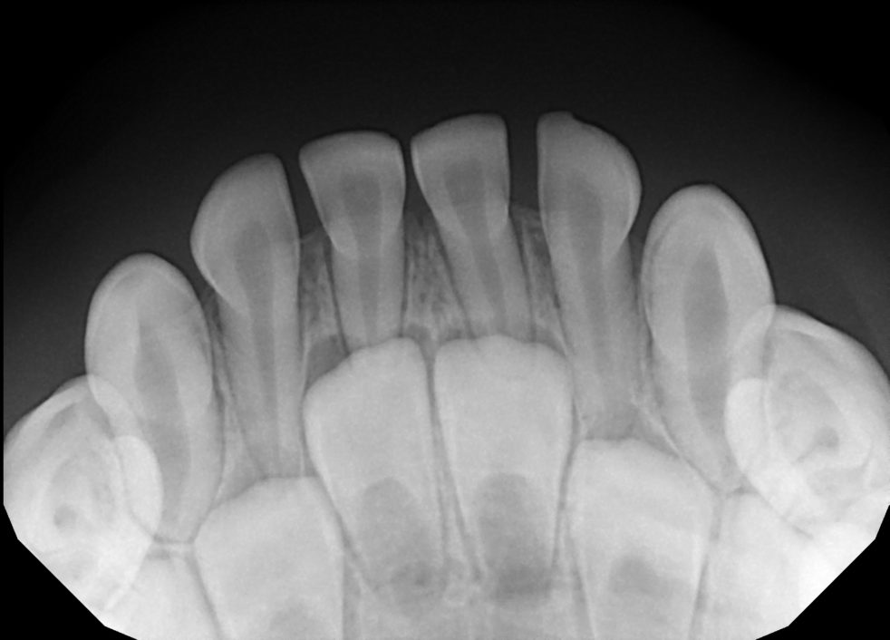 Dental XRays The Whole Tooth Pediatric Dental Blog