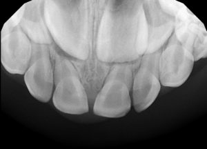 xray of baby teeth