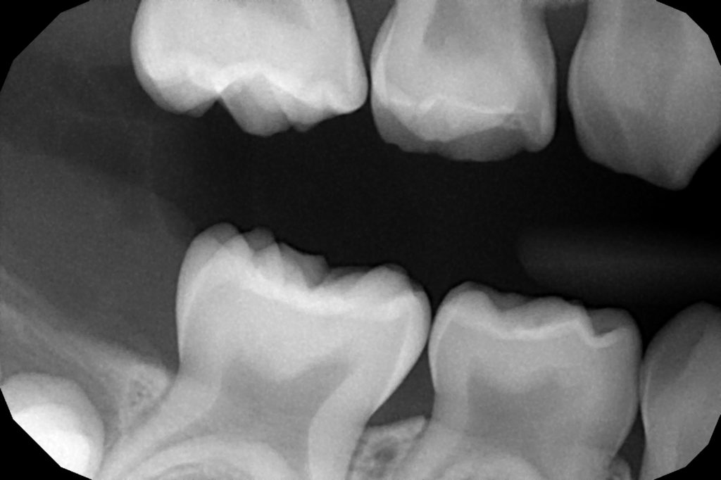 Dental XRays The Whole Tooth Pediatric Dental Blog